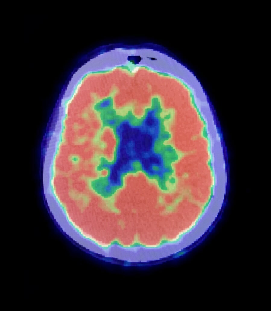 Human Brain PET Scan